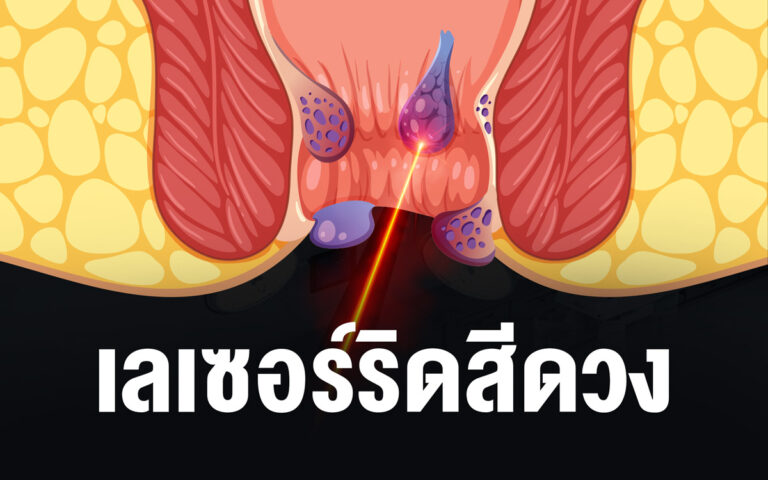 เลเซอร์ริดสีดวง